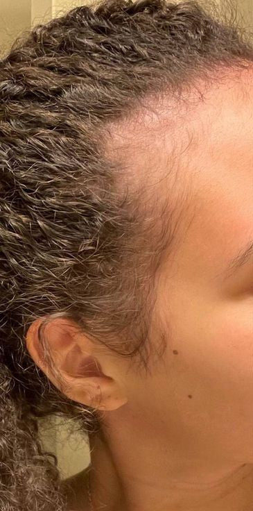 Less hair loss voor