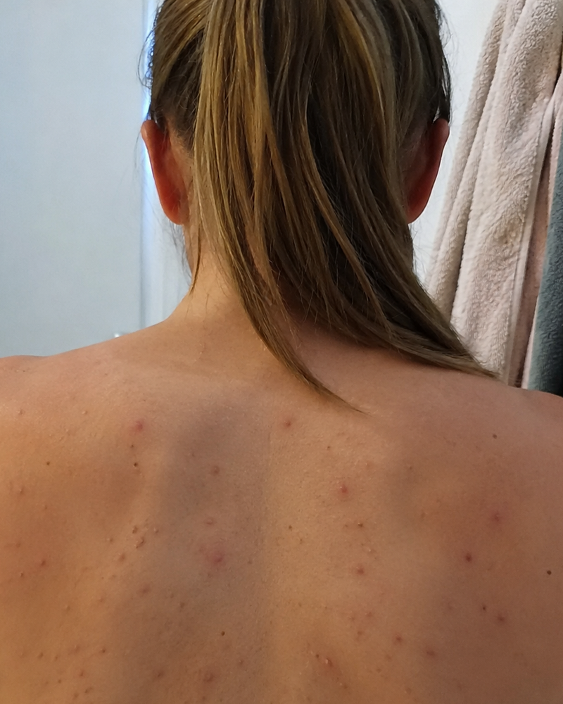Less irritated skin voor