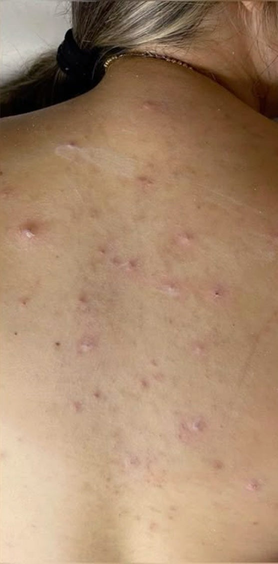 Less irritated skin voor